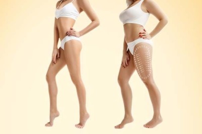 Transform Your Body Shape with Liposuction Surgery in Dubai by Dr. Anshu