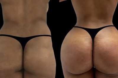 Best Aesthetic Clinic in dubai Prefer Hyacorp Fillers for Soft, Natural Results