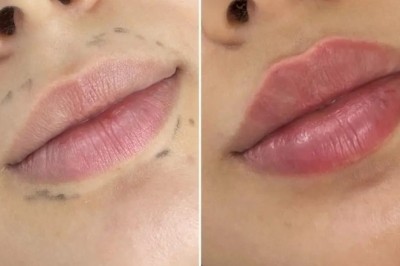 Juvederm for Marionette Lines by the Best Aesthetic Clinic in Dubai