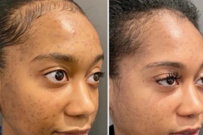 The Latest Chemical Peel Innovations from the Best Aesthetic Clinics in Dubai