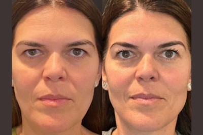 Why the Best Aesthetic Clinics in Dubai Are Turning to Thread Lift for a Natural Facelift