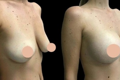 How the Best Breast Augmentation Surgeon in Dubai Ensures Safe and Successful Surgery