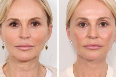 Transform Your Look Naturally and Safely with Expert Thread Lift in Dubai