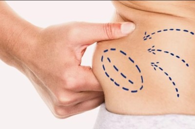 Radiant Transformation with Best Liposuction Doctors in Dubai