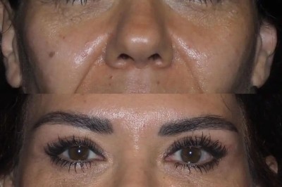 Who Is a Good Candidate for Eye Bag Removal Surgery in Dubai?
