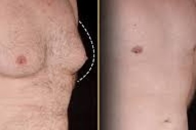 Gynecomastia in Dubai: A Growing Trend in Male Aesthetics