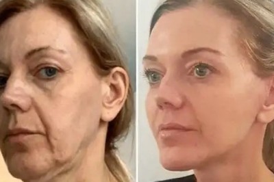 Refresh the Freshness using Profhilo at the Best Aesthetic Clinic in dubai