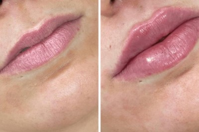 Juvederm Treatment in Dubai: which filler type suits your needs?