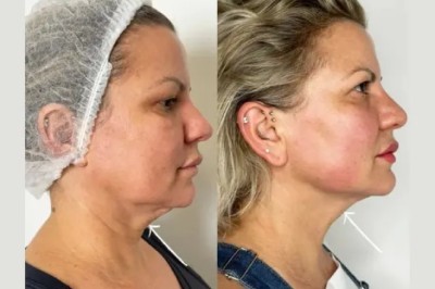 Endolift Treatments in Dubai: A Complete Guide for First-Time Patients