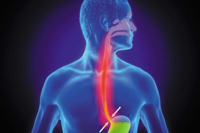 Acid Reflux Treatment in Dubai: Diagnosis and Solutions