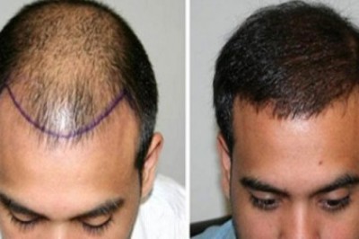 أفضل عيادات زراعة الشعر في دبي لعام 2025