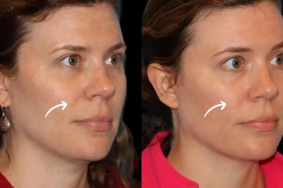 Sculptra Belly Firming at the Best Aesthetic Clinic in Dubai