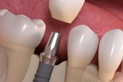 Tooth Implant Cost Dubai Explained in Simple Terms