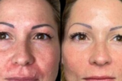 RadianceFlow from Best Aesthetic Clinics in dubai with Profhilo