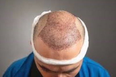 هل تحتاج جلسات إضافية بعد زراعة الشعر في الرياض؟