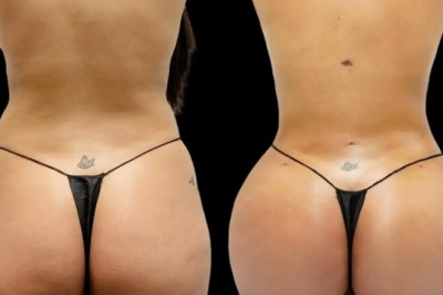 How Surgeons Achieve Natural Curves with Butt Fat Transfer in Dubai