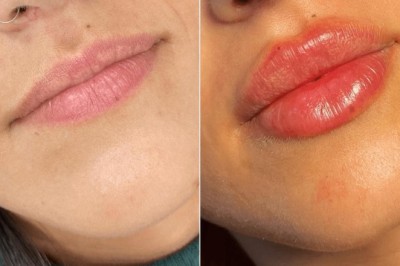 Juvederm Treatment in Dubai vs fillers abroad – which is better?