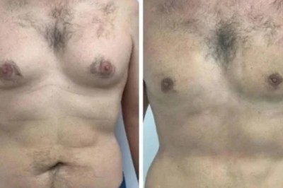 How the Best Gynecomastia Surgeons in Dubai Prepare Patients for a Smooth Healing Process