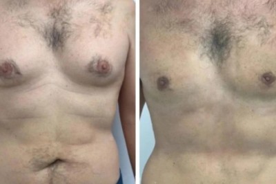 Post-Surgery Tips Recommended by the Best Gynecomastia Surgeons in Dubai