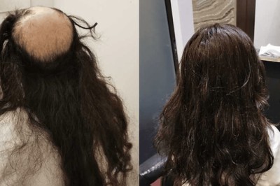 Hair Replacement SG