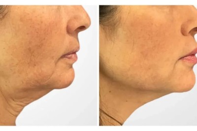 Thread Lift in Dubai for a Tightened, Refreshed Appearance