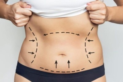 Liposuction in Dubai: Combining Aesthetic Precision with Medical Excellence