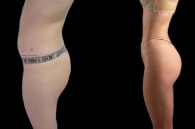 A Complete Guide to J-Plasma Offered by the Best Aesthetic Clinic in Dubai