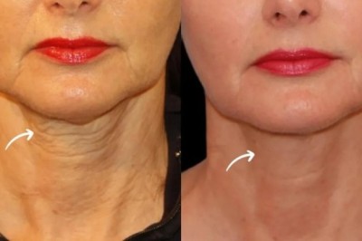 Best Aesthetic Clinic in Dubai for Sculptra Bio Sculpting
