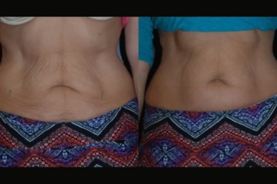 Experience Luxury Skin Tightening Care at the Best Aesthetic Clinic in Dubai