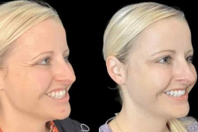 Best Plastic Surgeons in Dubai for Botox with Precision and Expertise