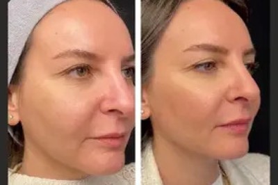 Best Plastic Surgeon in dubai for Mesotherapy Professional Treatment