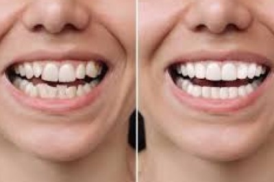 Before and After Invisalign Dubai: Real Smile Transformations