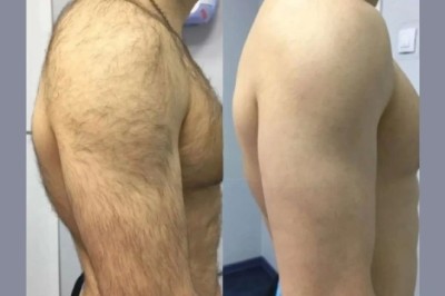 Best Aesthetic Clinic in dubai for Electrolysis Laser hair removal: Advanced Laser Tech