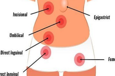 Understanding Hernia Surgery Cost in Singapore and What Affects It