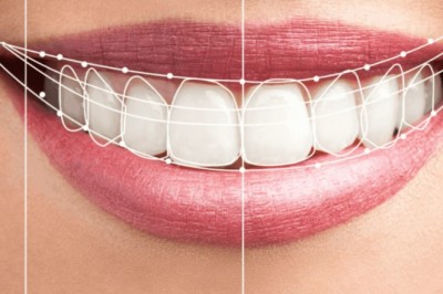 Hollywood Smile Makeover in Dubai: Transform Your Smile with Expert Dentists