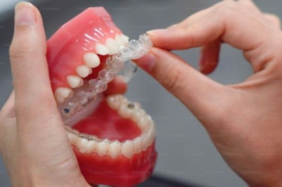 Teeth Aligners in Dubai: Everything You Need to Know Before Starting