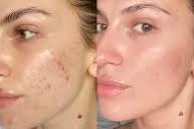 Before and After Results of Skinpen Microneedling in Altrincham