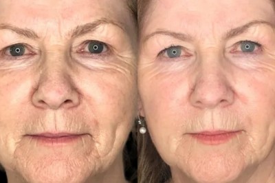 Best Aesthetic Clinic in Dubai for Precision Profhilo Application