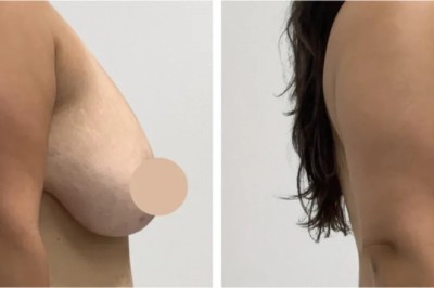 Best Breast Lift Surgeons in Dubai for Modern Breast Lift Techniques