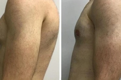 Best Gynecomastia Surgeons in Dubai Delivering Visible Improvements