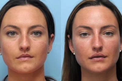 Thread Lift by Best Plastic Surgeons in Dubai for Confidence