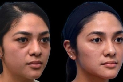 Best Plastic Surgeon in Dubai: Before and After Results of Dark Circles Treatment