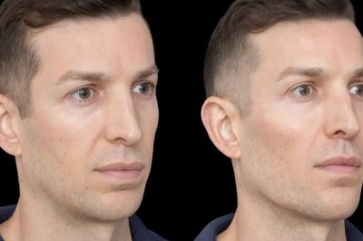 Jawline Fillers and Lifestyle Maintenance: Advice from the Best Plastic Surgeon in Dubai