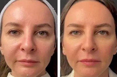 Mesotherapy Treatment in Dubai: Cost Guide & Treatment Packages