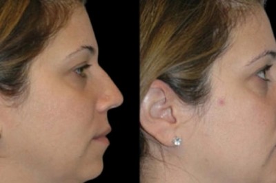 Rated Best Double chin removal Surgeons in dubai Info