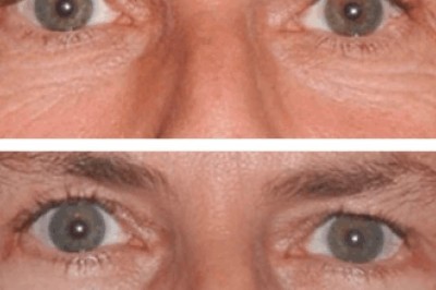 Eye Bag Removal in Dubai: Essential Pre-Treatment Checklist