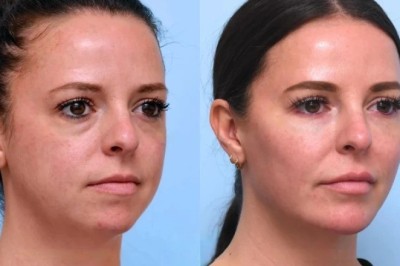 Best Plastic Surgeon in Dubai: Thread Lift Advanced Facial Contouring