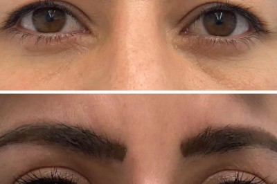 How to Prepare for Eye Bag Surgery – Best Eye bag removal Surgeon in dubai Checklist