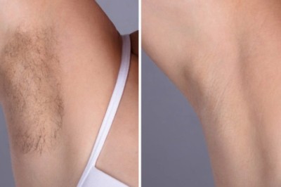 Laser hair removal Treatment in Dubai Using Advanced Technology