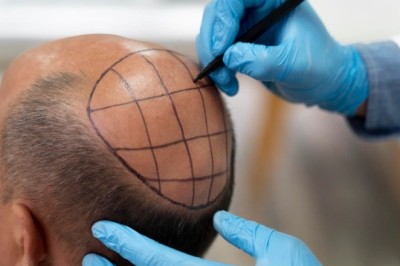 Hair Transplant Cost in Dubai for Informed Choices